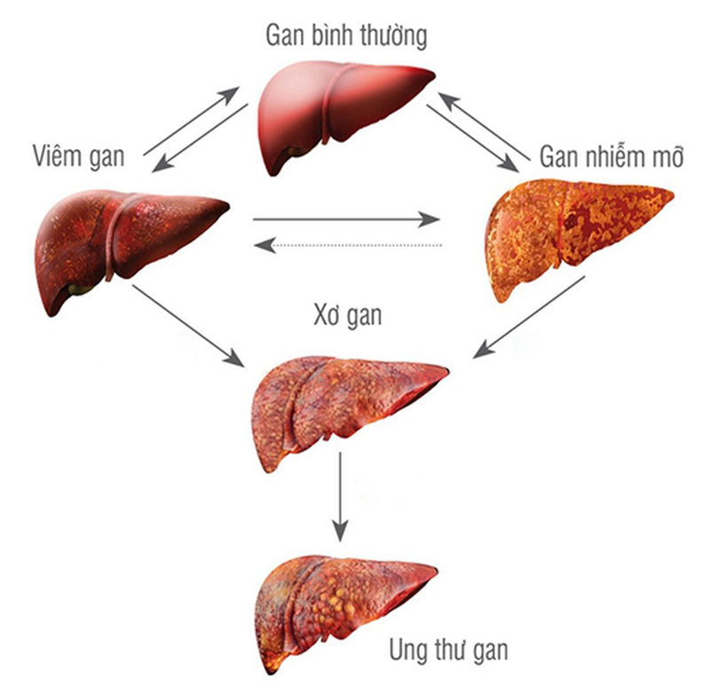 5 Dấu Hiệu Cảnh Báo Gan Có Vấn Đề Nhưng Lại Bị Coi Nhẹ
